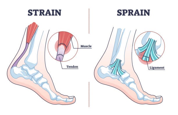1-sprains-and-strains