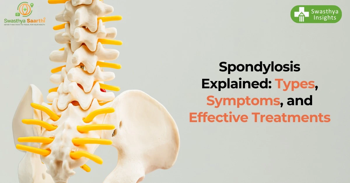 Spondylosis Explained: Types, Symptoms, and Effective Treatments