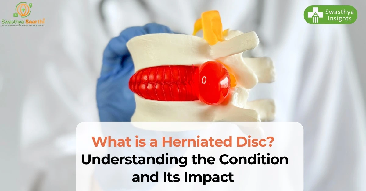What is a Herniated Disc? Understanding the Condition and Its Impact